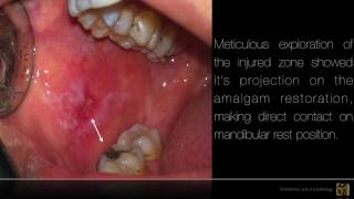 Amalgaminduced oral lichenoid lesion [upl. by Neillij34]