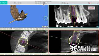 Planification implantaire avec MSOFT MIS [upl. by Ashly914]