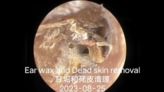 Ear wax and Dead skin removal耳垢和死皮清理20230825 [upl. by Thorwald796]