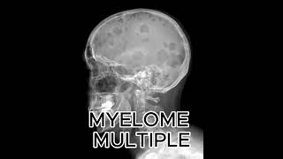 MYELOME MULTIPLE OU MALADIE DE KHALER [upl. by Okeim793]