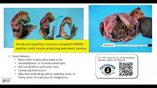 Pancreas Mucinous cystic neoplasm Gross pathology [upl. by Tut]