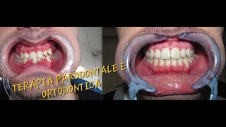 Periodontal and Orthodontic Therapy [upl. by Lana]