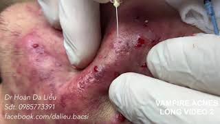 Dermatologistsqueeze pimpleswhitehead blackhead pustuleanti acnesVimpire acnes long video 2 [upl. by Ainecey]