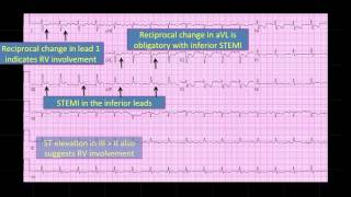 ECG2 Acute Inferoposterior MI involving RV [upl. by Noyk147]