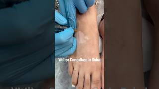 Vitiligo Camouflage in Dubaivitiligotreatment dubai abudhabi vitiligocamouflage [upl. by Enttirb]