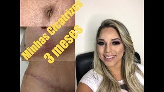 ABDOMINOPLASTIA  MAMOPLASTIA COM SILICONEquotMinhas cicatrizes e auto estima [upl. by Rinna]