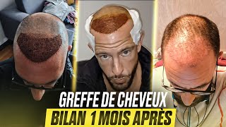 🟢J30 Greffe de Cheveux  1 Mois APRÈS mes Implants capillaire en Turquie🇹🇷 avec la Clinique Klineva [upl. by Diskson836]