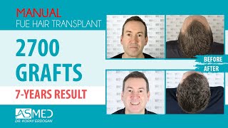 Manual FUE Hair Transplant 2700 Grafts 7 Years Result nationalgeographic asmedhairtransplant ​ [upl. by Ahsuatan]