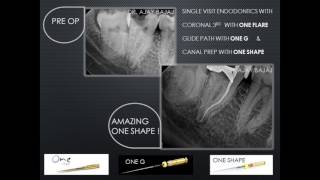 MANAGEMENT OF S SHAPED CANAL IN MANDIBULAR 2ND MOLAR [upl. by Ylelhsa]