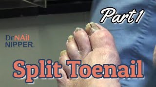 Fungal Toenails in the Podiatry Office Part 1 2021 [upl. by Lizabeth133]