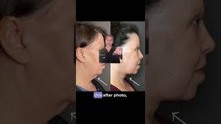 Should You Get a Necklift  Facelift Combo [upl. by Pihc327]