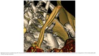 Innominate Artery Compression Syndrome Imaging [upl. by Bisset589]