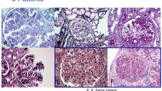 Understanding Membranoproliferative Glomerulonephritis Part 2 Hot Topic [upl. by Yelsa]