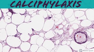 Calciphylaxis A Deadly Complication of End Stage Renal Disease ESRDChronic Kidney Disease [upl. by Nawk400]