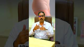 body contouring part 2 2 3 Dr lokesh insta 30 fps [upl. by Tekcirc]