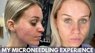 MY MICRONEEDLING EXPERIENCE amp Full Week Healing Process [upl. by Romalda]