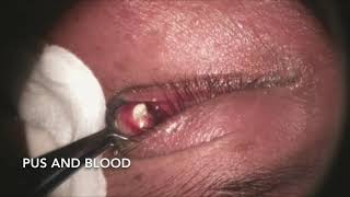 Incision and Drainage of Chalazion [upl. by Enialedam636]