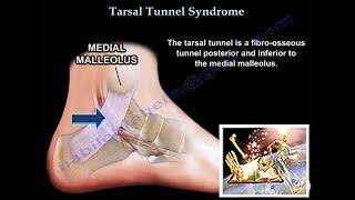 Tarsal Tunnel Syndrome  Everything You Need To Know  Dr Nabil Ebraheim [upl. by Knutson326]