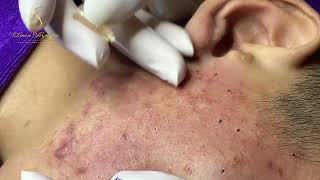 Loan Nguyen Acne Treatment 16288 [upl. by Heriberto557]