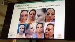 Caso clínico Alopecia frontal fibrosante  liquen plano pigmentoso Bucaramanga 2016 [upl. by Prue825]