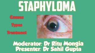 Staphyloma  Ophthalmology  For Medical Students [upl. by Ettecul]