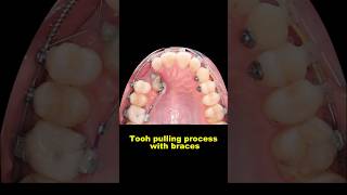 Pulling out hidden teeth when braces braces orthodontist dentist bracesoff [upl. by Car]