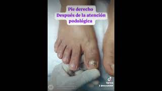 Micosis ungueal en tratamiento 👣 Andrea Gutierrez Podologa [upl. by Bushey]