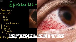 Episcleritis  Aetiology  pathogenesis  clinical features  treatment [upl. by Nytsua]