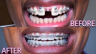 Full Braces Journey Time Lapse  3 Years Gaps Overbite Frenectomy  Starring Shameka [upl. by Verity]