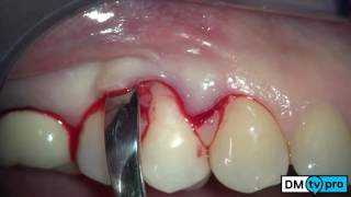 Single gingival recession treatment with Mucograft matrix [upl. by Jud]