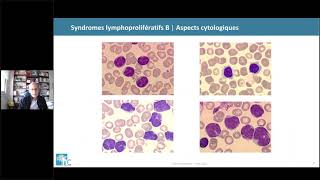 DES Hématologie 20202021  Leucémie lymphoïde chronique 12 [upl. by Crowley]