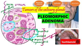 Pleomorphic Adenoma  Salivary gland tumors  DETAILED Textbook discussion Shafers  NEET MDSNBDE [upl. by Enived]