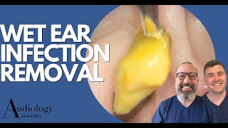 EAR INFECTION REMOVAL EP870 [upl. by Kokoruda]