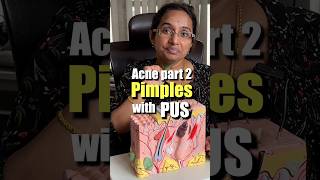 How To Treat Pus Filled Acne At Home  Papules amp Pustules trending [upl. by Aliam]