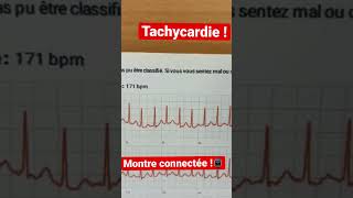 Une tachycardie sur la montre connectée [upl. by Auhsoj]