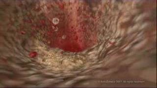 MEDICAL  How cholesterol clogs your arteries atherosclerosis [upl. by Nonnair98]