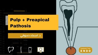 Pulp amp Preapical Pathosis  د اسماء دسوقي [upl. by Elleda615]