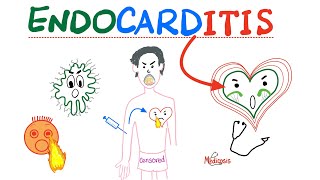 Infective Endocarditis  Fever amp New Murmur  Modified Duke’s Criteria  Cardiology Playlist [upl. by Anaitsirc643]