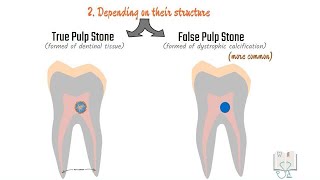 Pulp stones Denticles pulp dental [upl. by Cohleen]