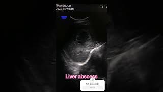 Liver abscess scanning… Subscribe like for ultrasound training medicalstudent radiology [upl. by Gimpel821]