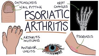 Psoriatic Arthritis [upl. by Anaujik]