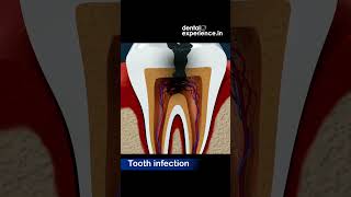 Tooth infection  Abscess  Caries  Symptoms  Treatments  Dentalexperiencein [upl. by Faun]