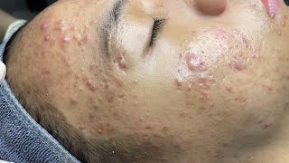 ACNE TREATMENT VU QUYNH MI Acne On Boys Cheek 2024 [upl. by Esinaej]