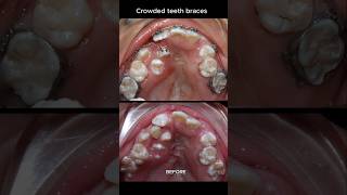 The most crowded teeth ive ever seen braces orthodontist dentist [upl. by Leinnad]