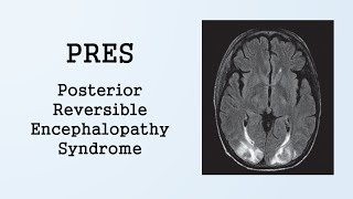 PRES Posterior Reversible Encephalopathy Syndrome [upl. by Arbmahs]