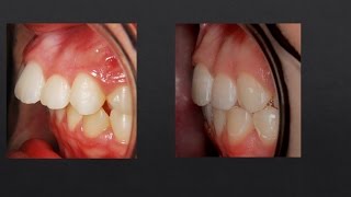 8mm Overjet Correction Orthodontics [upl. by Epner]