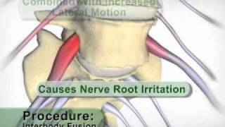 Anterior Lumbar Interbody Fusion [upl. by Yatnoed]