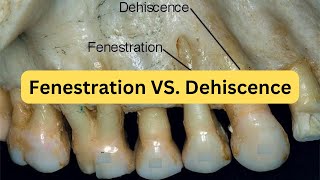 Difference between fenestration and dehiscence with mnemonic [upl. by Gothard]