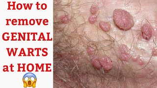 HOW TO GET RID OF GENITAL WARTS [upl. by Fiedler974]