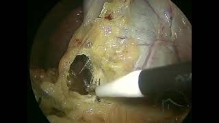 COLECISTECTOMIA POR VIDEOLAPAROSCOPIA  culture of safety in cholecystectomy [upl. by Hermia]